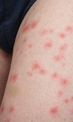 Photo de boutons avec piqûres sur la peau