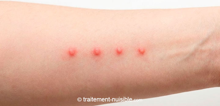 Piqûres de punaises de lit alignées sur un bras